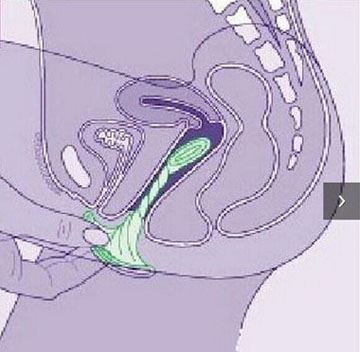 女用避孕套使用方法图（真人演示）